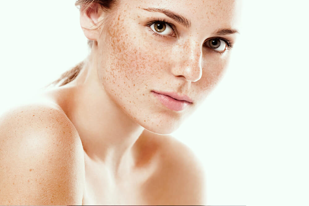 Девушка с пигментными пятнами по телу Девушка с пигментными пятнами по телу