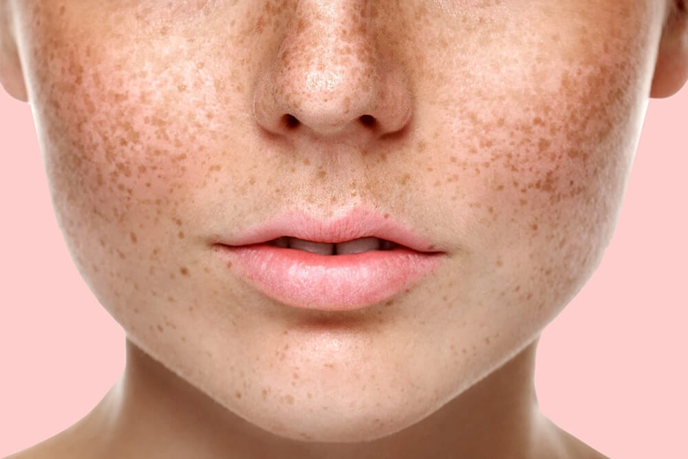 Девушка с пигментными пятнами Девушка с пигментными пятнами